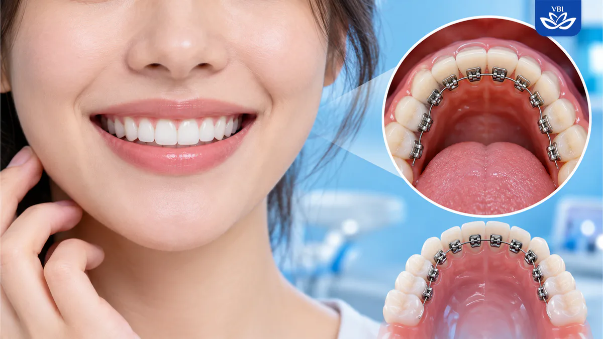 Cận cảnh niềng răng mặt lưỡi với hệ thống mắc cài kim loại gắn ở mặt trong cung răng