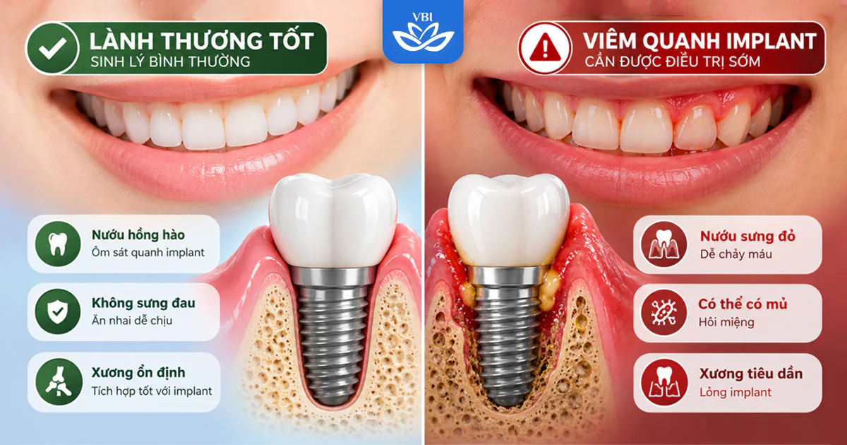 Nhận biết sớm biến chứng sau khi cấy implant: Dấu hiệu sưng đau lành tính và biến chứng nguy hiểm